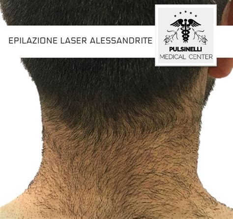 depilazione definitiva uomo genitali|Epilazione laser per uomo: quando e perché dovresti pensarci